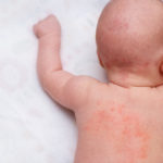 乳児湿疹・アトピー予防の保湿クリーム、正しい４つの選び方