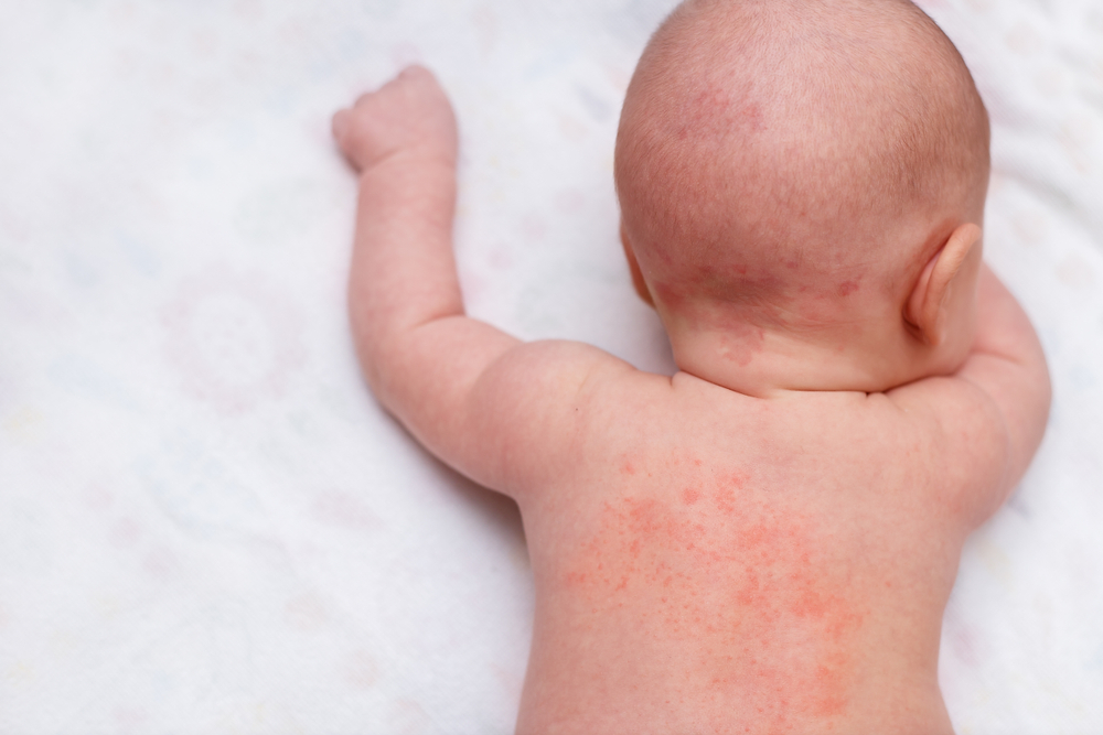 乳児湿疹・アトピー予防の保湿クリーム、正しい４つの選び方