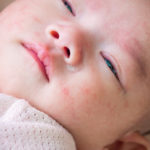 乳児湿疹・アトピー予防の保湿クリーム、間違った４つの選び方